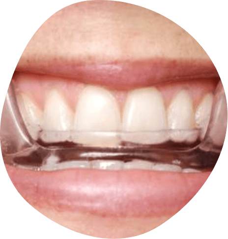 Close up of teeth wearing an oral appliance